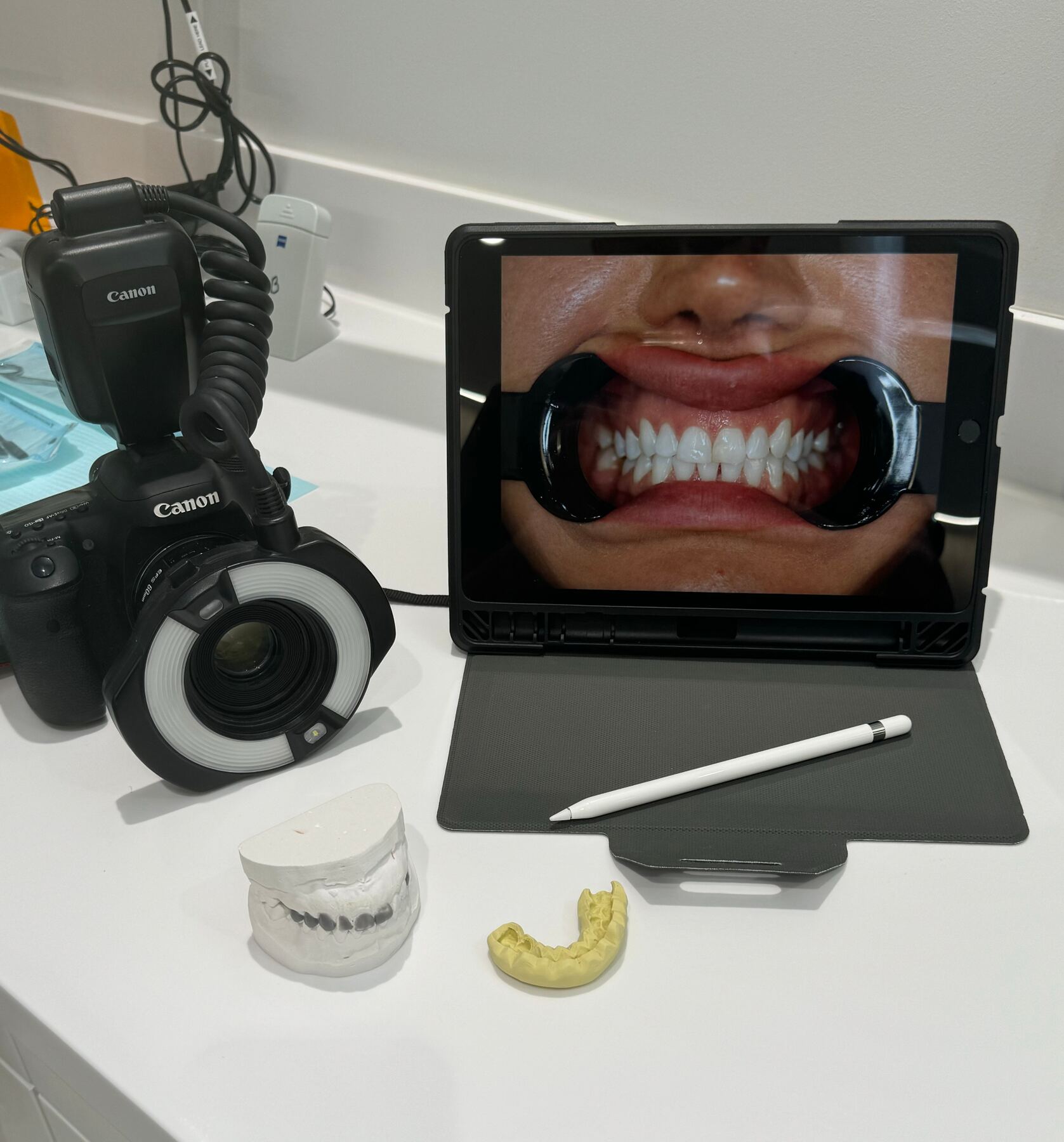 Macro camera, gypsum model and intra-oral photograph used for shade matching